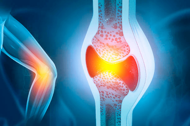 Prevenirea bolilor articulare