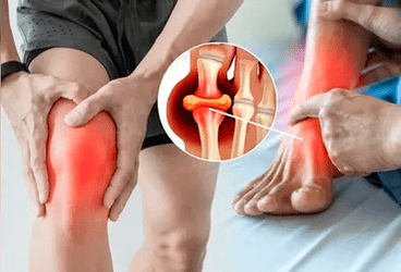 Schemă de aplicare a gelului Icexin în zona articulației genunchiului și a piciorului